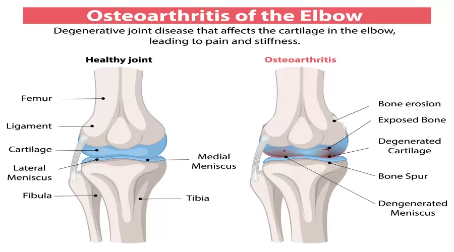 9 Next-Generation Medicines Fighting Obesity in the Pipeline
